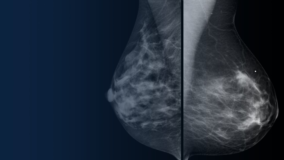 Revolutionizing Breast Cancer Imaging: How Pink Imaging is Helping to Save Lives